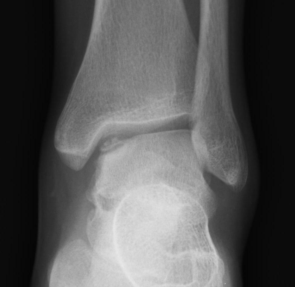 Talus OCD Medial Type IV